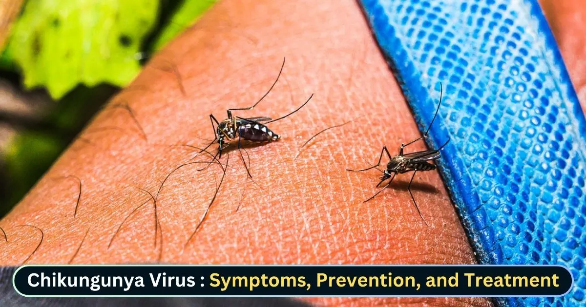 Chikungunya Virus 2025 Symptoms, Prevention & Treatment