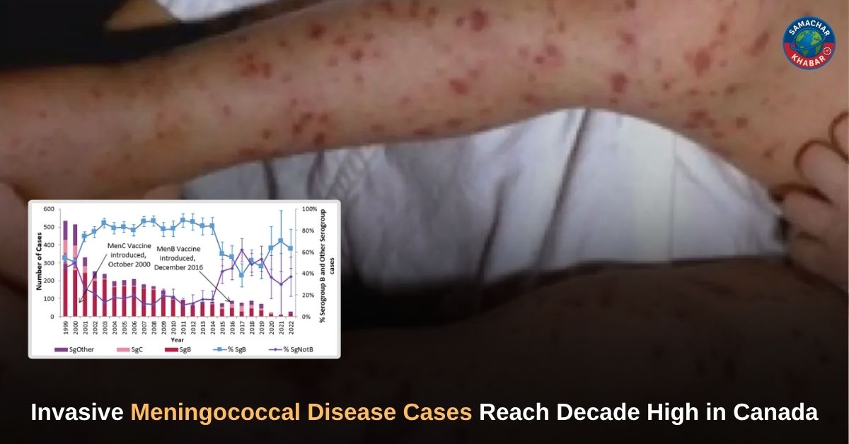 Invasive Meningococcal Disease Cases Reach Decade High in Canada
